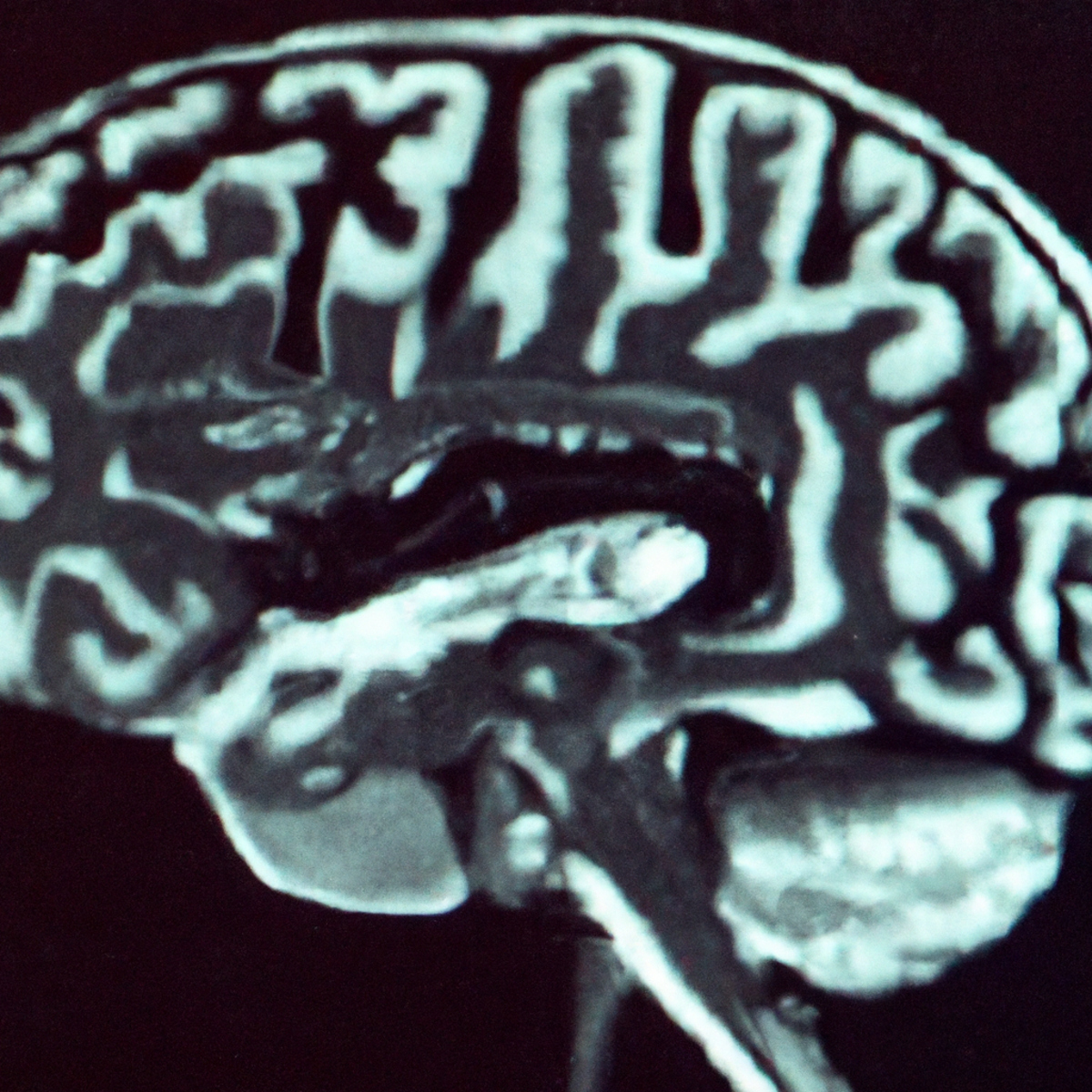 Abnormal brain scan revealing Rasmussen's Encephalitis.