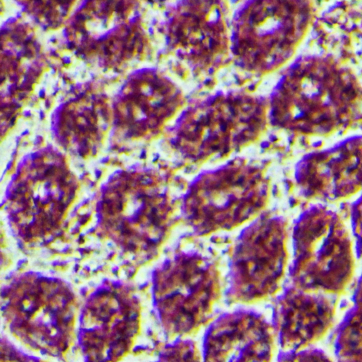 Close-up image of Langerhans cells stained with dyes, showcasing distinct morphology and abundant cytoplasmic granules - Langerhans Cell Histiocytosis (LCH)