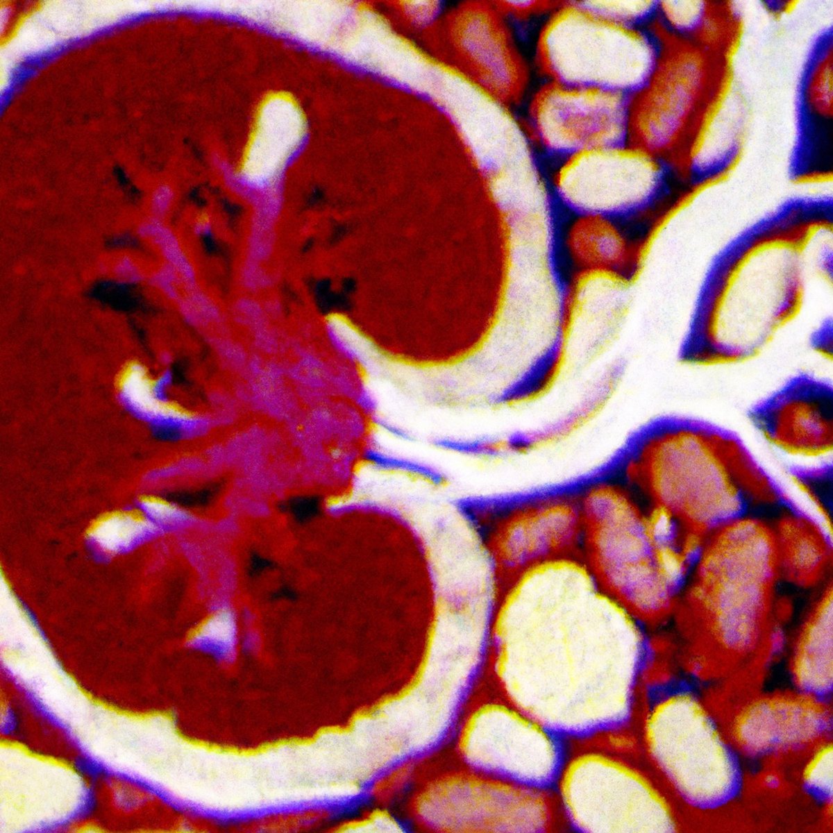 Close-up of medullary sponge kidney, showcasing unique texture, patterns, and contours caused by rare disorder.