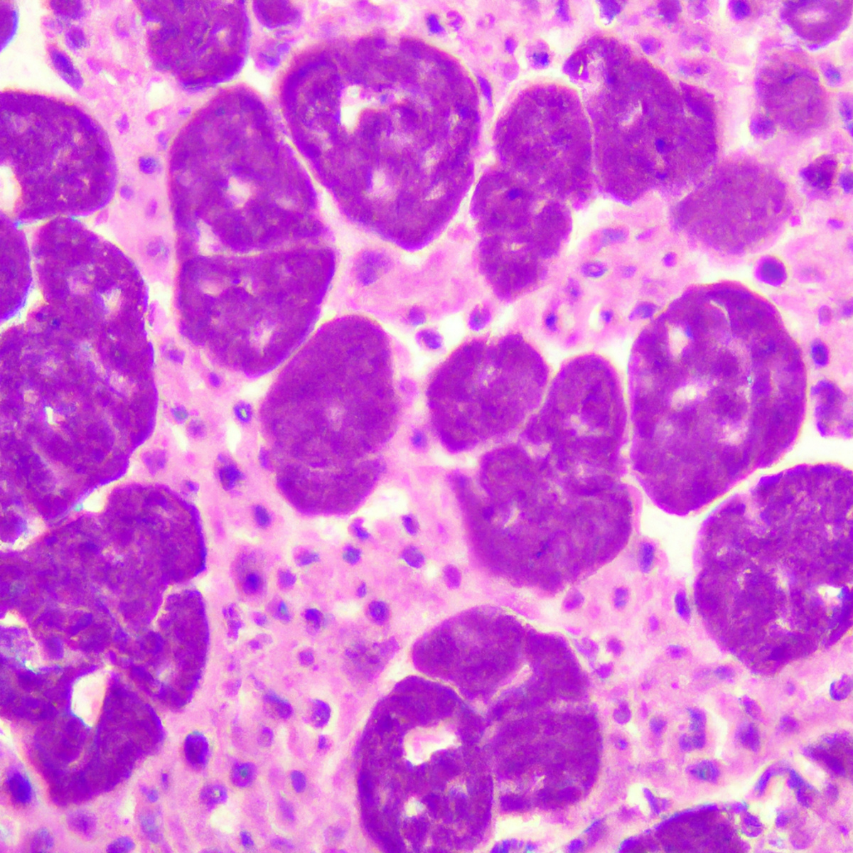 Microscopic view of purple and pink Pleuropulmonary Blastoma cells.