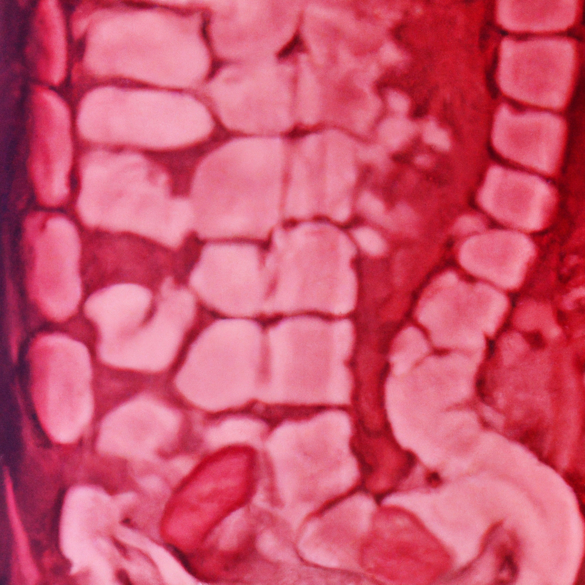 Enlarged, irregular gastric folds with inflamed, rough texture in shades of red and pink, representing Menetrier's Disease.