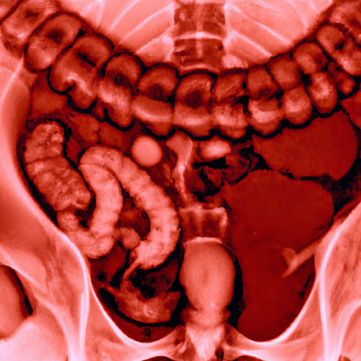 Close-up view of a stomach with Menetrier's Disease, showing enlarged folds and thickened mucous membrane.
