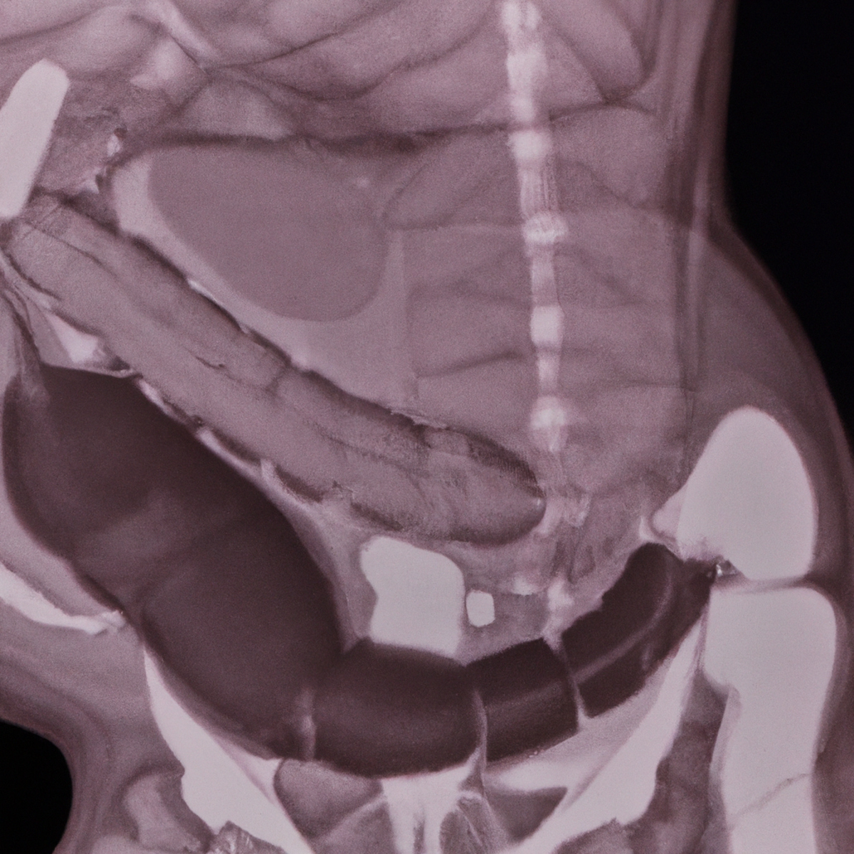 Close-up of healthy human abdomen with fully formed pancreas. Arrows highlight rare annular pancreas, surrounded by stomach and intestines. Detailed examination aids understanding of this medical condition.