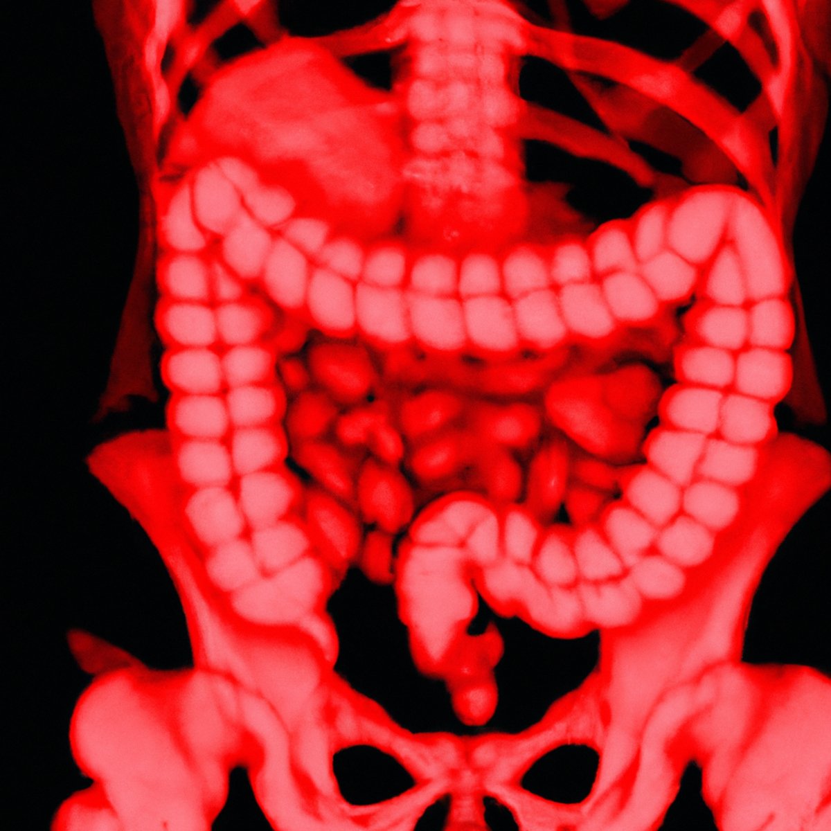 Close-up of stomach lining with thickened folds and enlarged gastric rugae, characteristic of Menetrier's Disease.