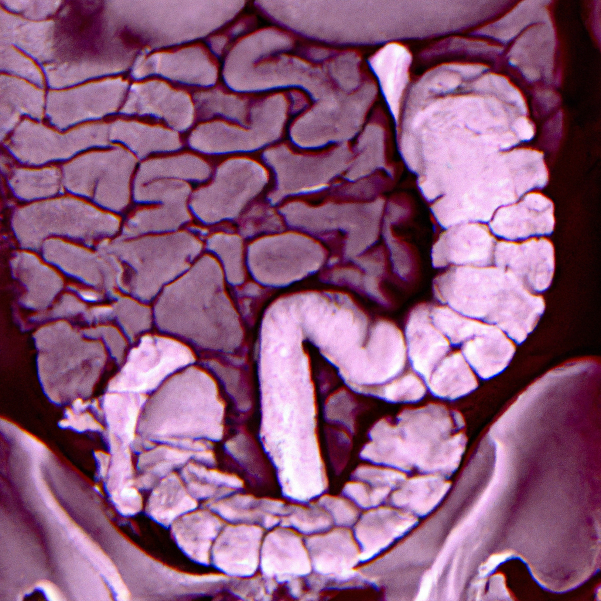 Close-up of inflamed stomach wall in eosinophilic gastroenteritis, revealing reddened and swollen tissues - Eosinophilic gastroenteritis