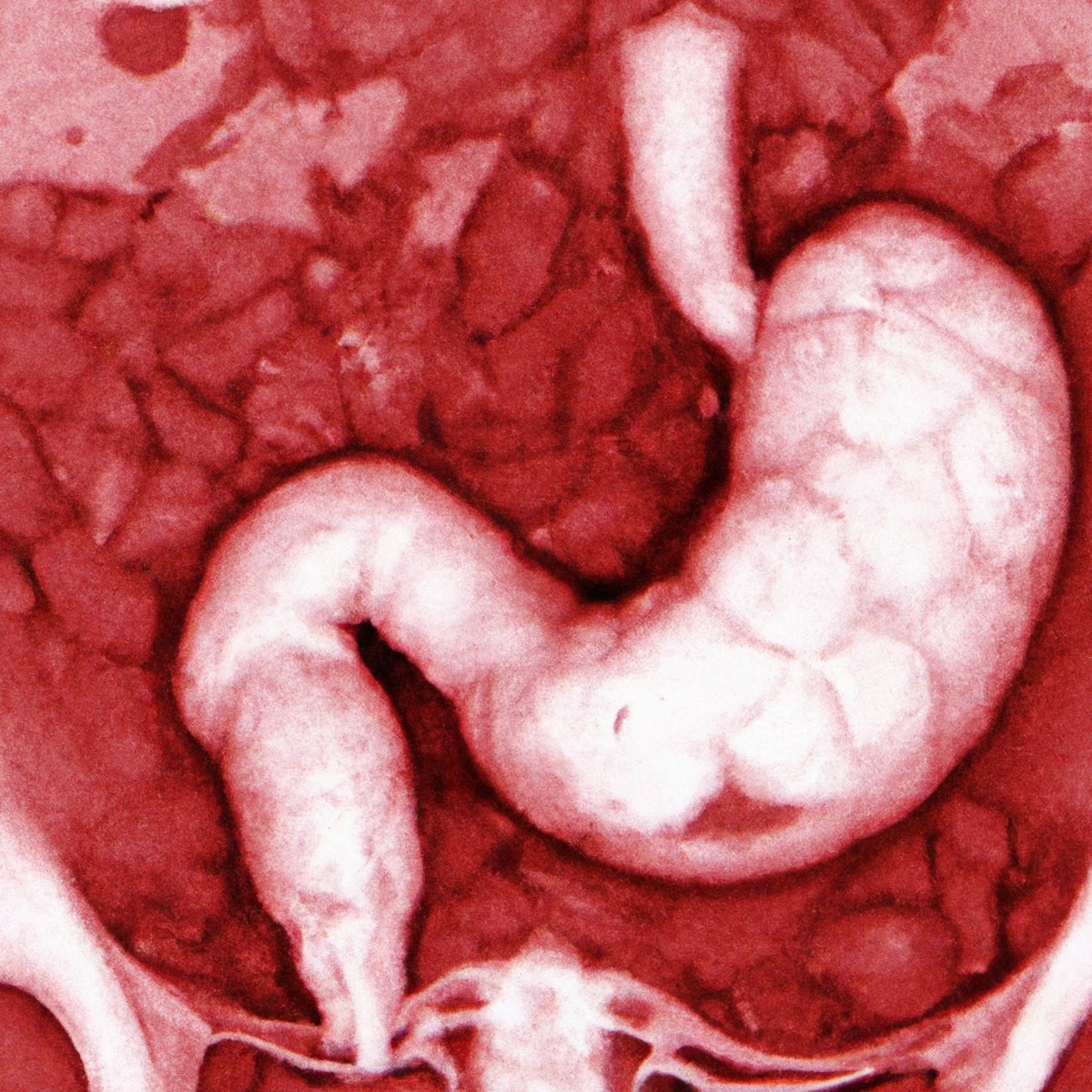 Inflamed gallbladder specimen with yellow nodules and thickened walls, illustrating Xanthogranulomatous Cholecystitis.